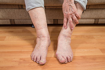 Geriatric Foot Care Treatment  Podiatrist, Foot Doctor San