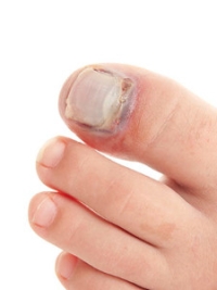 How to Tell if You Have a Broken Toe