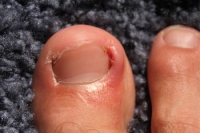 Signs of an Ingrown Toenail