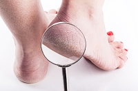 Causes of Cracked Heels